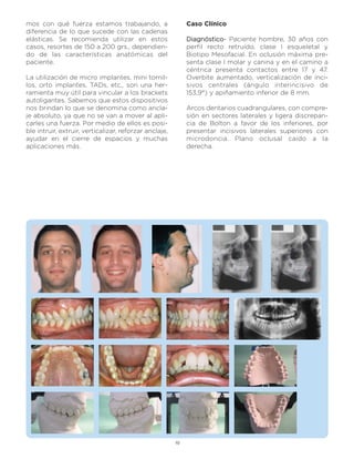 mos con qué fuerza estamos trabajando, a                     Caso Clínico
diferencia de lo que sucede con las cadenas
elásticas. Se recomienda utilizar en estos                   Diagnóstico- Paciente hombre, 30 años con
casos, resortes de 150 a 200 grs., dependien-                perfil recto retruído, clase I esqueletal y
do de las características anatómicas del                     Biotipo Mesofacial. En oclusión máxima pre-
paciente.                                                    senta clase I molar y canina y en el camino a
                                                             céntrica presenta contactos entre 17 y 47.
La utilización de micro implantes, mini tornil-              Overbite aumentado, verticalización de inci-
los, orto implantes, TADs, etc., son una her-                sivos centrales (ángulo interincisivo de
ramienta muy útil para vincular a los brackets               153,9°) y apiñamiento inferior de 8 mm.
autoligantes. Sabemos que estos dispositivos
nos brindan lo que se denomina como ancla-                   Arcos dentarios cuadrangulares, con compre-
je absoluto, ya que no se van a mover al apli-               sión en sectores laterales y ligera discrepan-
carles una fuerza. Por medio de ellos es posi-               cia de Bolton a favor de los inferiores, por
ble intruir, extruir, verticalizar, reforzar anclaje,        presentar incisivos laterales superiores con
ayudar en el cierre de espacios y muchas                     microdoncia. Plano oclusal caído a la
aplicaciones más.                                            derecha.




                                                        10
 