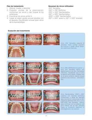 Plan de tratamiento                                   Resumen de Arcos Utilizados:
1. Alienar, nivelar y desrotar.                       .014” Sentalloy,
2. Preparar anclaje de la prescripción,               .018” x .018” Bioforce;
   conformar los arcos y dar torque la los            .019” x .025” NeoSentalloy,
   anteriores.                                        .021” x .025” NeoSentalloy,
3. Coordinar los arcos entre sí.                      .0215” x .028” NeoSentalloy,
4. Logar el mejor ajuste oclusal posible con          .021” x .025” acero y .021” x .025” braided.
   el aparato. Equilibrado oclusal post retiro
   de la Aparatología.




 Evolución del tratamiento




                                                                      Arco ,014” Sentalloy superior 8
                                                                      semanas, hasta corregir posición
                                                                      de incisivos y poder ubicar brack-
                                                                      ets cerámicos inferiores.




                                                                      Arco ,018”x,018”Bioforce superior y
                                                                      arco ,014” Sentalloy inferior con
                                                                      elastómeros en los 2os. Premolares
                                                                      inferiores, impidiendo que el arco
                                                                      se deslice hacia distal y trabaje más
                                                                      en el sector anterior, dando torque
                                                                      positivo a los incisivos verticaliza-
                                                                      dos.




                                                                      Arco NeoSentalloy ,0215”x ,028”
                                                                      superior con resortes Sentalloy
                                                                      comprimido a distal de laterales
                                                                      para reconstruir y solucionar la dis-
                                                                      crepancia dentaria inter arco y arco
                                                                      019”x,025” Neo Sentalloy inferior
                                                                      para continuar con la nivelación del
                                                                      arco inferior. No se han utilizado
                                                                      hasta el momento elásticos ni
                                                                      retroligaduras a los caninos.



                                                 11
 