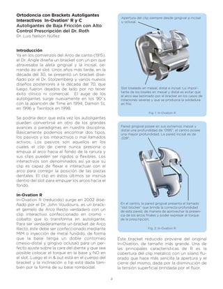 Ortodoncia con Brackets Autoligantes
                                                         Apertura del clip siempre desde gingival a incisal
Interactivos In-Ovation® R y C                           u oclusal.
Autoligantes de Baja Fricción con Alto
Control Prescripción del Dr. Roth
Dr. Luis Nelson Núñez


Introducción
Ya en los comienzos del Arco de canto (1915),
el Dr. Angle diseña un bracket con un pin que
atravesaba la aleta gingival y la incisal, ce-
rrando así el slot. Unos años más tarde, en la
década del 30, se presentó un bracket dise-
ñado por el Dr. Stolzemberg y varios nuevos
diseños posteriores a la década del 70, que
luego fueron dejados de lado por no tener               Slot biselado en mesial, distal e incisal. Lo impor-
                                                        tante de los biseles en mesial y distal es evitar que
éxito clínico ni comercial. El auge de los              el arco sea lastimado por el bracket en los casos de
autoligantes surge nuevamente en los 90´s               rotaciones severas y que se produzca la soldadura
con la aparición de Time en 1994, Damon SL              en frío.
en 1996 y Twinlock en 1998.
                                                                          Fig. 1: In-Ovation R
Se podría decir que esta vez los autoligantes
pueden convertirse en otro de los grandes
avances o paradigmas en nuestra disciplina.             Pared gingival posee en sus extremos mesial y
                                                        distal una profundidad de ‘0185”, el centro posee
Básicamente podemos encontrar dos tipos,                una mayor profundidad. La pared incisal es de
los pasivos y los interactivos o mal llamados           .028”.
activos. Los pasivos son aquellos en los
cuales el clip de cierre nunca presiona o
empuja al arco hacia el fondo de la ranura y
sus clips pueden ser rígidos o flexibles. Los
interactivos son denominados así ya que su
clip es capaz de flexar e interactuar con el
arco para corregir la posición de las piezas
dentales. El clip en éstos últimos se insinúa
dentro del slot para empujar los arcos hacia el
fondo.

In-Ovation R
In-Ovation R (reducido) surge en 2002 dise-
ñado por el Dr. John Voudouris, es un brack-            En el centro, la pared gingival presenta el llamado
                                                        “slot blocker” que brinda la correcta profundidad
et gemelo de Arco Recto verdadero con un                de esta pared, de manera de aprovechar la presen-
clip interactivo confeccionado en cromo -               cia de los arcos finales y poder expresar el torque
cobalto que lo transforma en autoligante.               de la prescripción.
Para ser verdaderamente un bracket de Arco
Recto, éste debe ser confeccionado mediante                              Fig. 2: In-Ovation R
MIM o inyección de metal fundido, de forma
que la base tenga un doble contorneo                   Éste bracket reducido proviene del original
(mesio-distal y gíngivo oclusal) para un per-          In-Ovation, de tamaño más grande. Una de
fecto ajuste sobre la cara del diente y que sea        las principales características de R es la
posible colocar el torque en la base y NO en           cobertura del clip metálico con un silano flu-
el slot. Luego el in & out está en el cuerpo del       orado que hace más sencilla la apertura y el
bracket y la inclinación o tip está dada tam-          cierre del mismo, dada por la disminución de
bién por la forma de su base romboidal.                la tensión superficial brindada por el flúor.

                                                   2
 