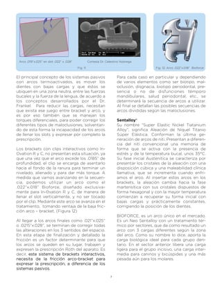 Arco ,019”x,025” en slot ,022” x ,028”             Cortesía Dr. Celestino Nobrega

                                          Fig. 11                                           Fig. 12: Arco .022”x.018” Bioforce


El principal concepto de los sistemas pasivos                           Para cada caso en particular y dependiendo
con arcos termoactivados, es mover los                                  de varios elementos como ser biotipo, mal-
dientes con bajas cargas y que éstos se                                 oclusión, disgnacia, biotipo periodontal, pre-
ubiquen en una zona neutra, entre las fuerzas                           sencia o no de disfunciones témporo
bucales y la fuerza de la lengua, de acuerdo a                          mandibulares, salud periodontal, etc., se
los conceptos desarrollados por el Dr.                                  determinará la secuencia de arcos a utilizar.
Frankel. Para reducir las cargas, necesitan                             Al final se detallan las posibles secuencias de
que exista ese juego entre bracket y arco, y                            arcos divididas según las maloclusiones.
es por eso también que se manejan los
torques diferenciales, para poder corregir los                          Sentalloy®
diferentes tipos de maloclusiones, solventan-                           Su nombre “Super Elastic Nickel Tiatanium
do de esta forma la incapacidad de los arcos                            Alloy”, significa Aleación de Níquel Titanio
de llenar los slots y expresar por completo la                          Súper Elástica. Conforman la última ge-
prescripción.                                                           neración de arcos de niti. Presentan a diferen-
                                                                        cia del niti convencional una memoria de
Los brackets con clips interactivos como In-                            forma que se activa con la presencia de
Ovation R y C, no presentan esta situación, ya                          estrés y de la temperatura bucal, unos 35°C.
que una vez que el arco excede los .0185” de                            Su fase inicial Austenítica se caracteriza por
profundidad, el clip se encarga de asentarlo                            presentar los cristales de la aleación con una
hacia el fondo de la ranura para terminar un                            disposición cúbica y una maleabilidad clínica
nivelado, alienado y para dar más torque. A                             llamativa, que se incrementa cuando enfri-
medida que vamos avanzando en la secuen-                                amos el arco. Al insertar estos arcos en los
cia, podemos utilizar un arco como el                                   brackets, la aleación cambia hacia la fase
.022”x.018” Bioforce, diseñado exclusiva-                               martensítica con sus cristales dispuestos de
mente para In-0vation R y C, de manera de                               forma hexagonal y con la mayor temperatura
llenar el slot verticalmente, y no ser tocado                           comienzan a recuperar su forma inicial con
por el clip. Mediante este arco se avanza en el                         bajas cargas y prácticamente constantes,
tratamiento, tomando ventaja de la baja fric-                           corrigiendo la posición de los dientes.
ción arco – bracket. (Figura 12)
                                                                        BIOFORCE, es un arco único en el mercado.
Al llegar a los arcos finales como .021”x.025”                          Es un Neo Sentalloy con un tratamiento tér-
o .0215”x.028”, se terminan de corregir todas                           mico por sectores, que da como resultado un
las alteraciones en los 3 sentidos del espacio.                         arco con 3 cargas diferentes según la zona
En esta etapa de finalización y detallado la                            del arco. Como su nombre lo dice, aporta la
fricción es un factor determinante para que                             carga biológica ideal para cada grupo den-
los arcos se queden en su lugar, trabajen y                             tario. En el sector anterior libera una carga
expresen la prescripción Roth del aparato. Es                           ligera para el grupo incisivo, una carga inter-
decir, este sistema de brackets interactivos,                           media para caninos y bicúspides y una más
necesita de la fricción arco-bracket para                               pesada aún para los molares.
expresar la prescripción, a diferencia de los
sistemas pasivos.

                                                                   7
 