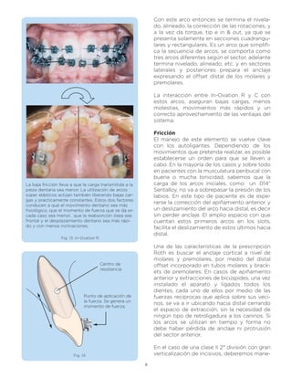 Con este arco entonces se termina el nivela-
                                                             do, alineado, la corrección de las rotaciones, y
                                                             a la vez da torque, tip e in & out, ya que se
                                                             presenta solamente en secciones cuadrangu-
                                                             lares y rectangulares. Es un arco que simplifi-
                                                             ca la secuencia de arcos, se comporta como
                                                             tres arcos diferentes según el sector, adelante
                                                             termina nivelado, alineado, etc. y en sectores
                                                             laterales y posteriores prepara el anclaje
                                                             expresando el offset distal de los molares y
                                                             premolares.

                                                             La interacción entre In-Ovation R y C con
                                                             estos arcos, aseguran bajas cargas, menos
                                                             molestias, movimientos más rápidos y un
                                                             correcto aprovechamiento de las ventajas del
                                                             sistema.

                                                             Fricción
                                                             El manejo de este elemento se vuelve clave
                                                             con los autoligantes. Dependiendo de los
                                                             movimientos que pretenda realizar, es posible
                                                             establecerse un orden para que se lleven a
                                                             cabo. En la mayoría de los casos y sobre todo
                                                             en pacientes con la musculatura peribucal con
                                                             buena o mucha tonicidad, sabemos que la
La baja fricción lleva a que la carga transmitida a la       carga de los arcos iniciales, como un .014”
pieza dentaria sea menor. La utilización de arcos            Sentalloy, no va a sobrepasar la presión de los
súper elásticos actúan también liberando bajas car-          labios. En este tipo de paciente es de espe-
gas y prácticamente constantes. Estos dos factores
                                                             rarse la corrección del apiñamiento anterior y
conducen a que el movimiento dentario sea más
fisiológico, que el momento de fuerza que se da en           un deslizamiento del arco hacia distal, es decir
cada caso sea menor, que la reabsorción ósea sea             sin perder anclaje. El amplio espacio con que
frontal y el desplazamiento dentario sea más rápi-           cuentan estos primeros arcos en los slots,
do y con menos inclinaciones.                                facilita el deslizamiento de estos últimos hacia
                                                             distal.
                 Fig. 13: In-Ovation R

                                                             Una de las características de la prescripción
                                                             Roth es buscar el anclaje cortical a nivel de
                                                             molares y premolares, por medio del distal
                                         Centro de           offset incorporado en tubos molares y brack-
                                         resistencia
                                                             ets de premolares. En casos de apiñamiento
                                                             anterior y extracciones de bicúspides, una vez
                                                             instalado el aparato y ligados todos los
                                                             dientes, cada uno de ellos por medio de las
                             Punto de aplicación de          fuerzas recíprocas que aplica sobre sus veci-
                             la fuerza. Se genera un
                                                             nos, se va a ir ubicando hacia distal cerrando
                             momento de fuerza.
                                                             el espacio de extracción, sin la necesidad de
                                                             ningún tipo de retroligadura a los caninos. Si
                                                             los arcos se utilizan en tiempo y forma no
                                                             debe haber pérdida de anclaje ni protrusión
                                                             del sector anterior.

                                                             En el caso de una clase II 2° división con gran
                       Fig. 14                               verticalización de incisivos, deberemos mane-

                                                         8
 