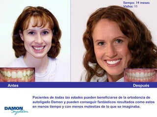 Pacientes de todas las edades pueden beneficiarse de la ortodoncia de 
autoligado Damon y pueden conseguir fantásticos resultados como estos 
en menos tiempo y con menos molestias de lo que se imaginaba. 
Antes 
Tiempo: 19 meses 
Visitas: 11 
Después 
 