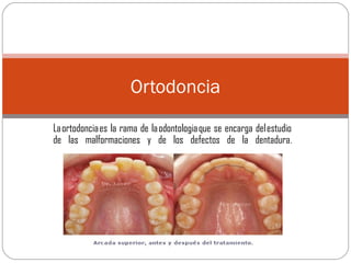La ortodoncia es la rama de la odontologia que se encarga del estudio
de las malformaciones y de los defectos de la dentadura.
Ortodoncia
 