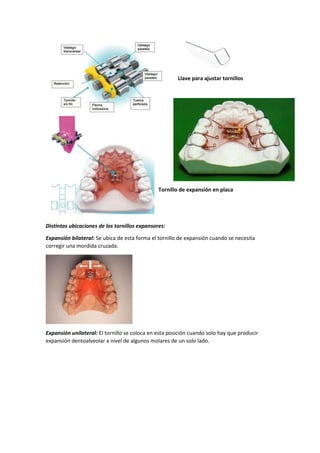 Llave para ajustar tornillos
Tornillo de expansión en placa
Distintas ubicaciones de los tornillos expansores:
Expansión bilateral: Se ubica de esta forma el tornillo de expansión cuando se necesita
corregir una mordida cruzada.
Expansión unilateral: El tornillo se coloca en esta posición cuando solo hay que producir
expansión dentoalveolar a nivel de algunos molares de un solo lado.
 