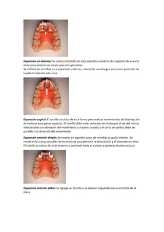 Expansión en abanico: Se coloca el tornillo en esta posición cuando la discrepancia de espacio
en la zona anterior es mayor que en la posterior.
Se utilizan los tornillos para expansión anterior, colocando una bisagra en la zona posterior de
la placa trabando esta zona.
Expansión sagital: El tornillo se ubica de esta forma para realizar movimientos de distalización
de molares para ganar espacios. El tornillo debe estar colocado de modo que el eje del mismo
esté paralelo a la dirección del movimiento y al plano oclusal; y el corte de acrílico debe ser
paralelo a la dirección del movimiento.
Expansión anterior simple: Se emplea en aquellos casos de mordida cruzada anterior. Se
recubren las caras oclusales de los molares para permitir la desoclusión y el destrabe anterior.
El tornillo se coloca los más anterior y profundo hacia el paladar y paralelo al plano oclusal.
Expansión anterior doble: Se agrega un tornillo y se colocan angulados hacia el centro de la
placa.
 