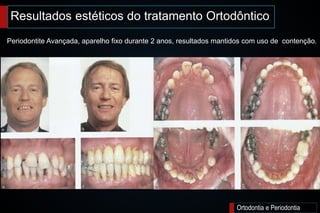 Ortodontia e Periodontia
Periodontite Avançada, aparelho fixo durante 2 anos, resultados mantidos com uso de contenção.
Resultados estéticos do tratamento Ortodôntico
 