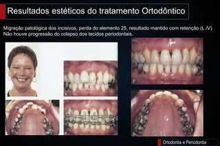 Ortodontia e Periodontia
Migração patológica dos incisivos, perda do elemento 25, resultado mantido com retenção (L /V)
Não houve progressão do colapso dos tecidos periodontais.
Resultados estéticos do tratamento Ortodôntico
 