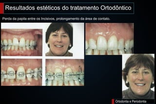 Ortodontia e Periodontia
Perda da papila entre os Incisivos, prolongamento da área de contato.
Resultados estéticos do tratamento Ortodôntico
 