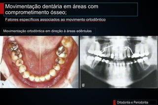 Movimentação dentária em áreas com
comprometimento ósseo;
Ortodontia e Periodontia
Fatores específicos associados ao movimento ortodôntico
Movimentação ortodôntica em direção à áreas edêntulas
 