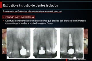 Extrusão e intrusão de dentes isolados;
Ortodontia e Periodontia
 A extrusão ortodôntica de um único dente que precisa ser extraído é um método
excelente para melhorar o nível marginal ósseo;
Fatores específicos associados ao movimento ortodôntico
Extrusão com periodonto
 