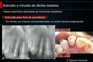 Extrusão e intrusão de dentes isolados;
Ortodontia e Periodontia
 Em dentes com fraturas coronorradiculares, ou outras fraturas subgengivais;
Fatores específicos associados ao movimento ortodôntico
Extrusão para fora do periodonto
 