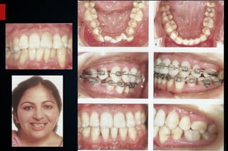 Ortodontia e Periodontia
 FIG 31.24
 
