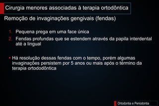 Cirurgia menores associadas à terapia ortodôntica
Ortodontia e Periodontia
1. Pequena prega em uma face única
2. Fendas profundas que se estendem através da papila interdental
até a lingual
 Há resolução dessas fendas com o tempo, porém algumas
invaginações persistem por 5 anos ou mais após o término da
terapia ortododôntica
Remoção de invaginações gengivais (fendas)
 