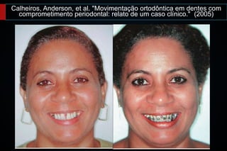 Calheiros, Anderson, et al. "Movimentação ortodôntica em dentes com
comprometimento periodontal: relato de um caso clínico." (2005)
 