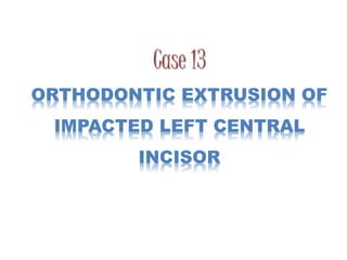 Case 13
ORTHODONTIC EXTRUSION OF
IMPACTED LEFT CENTRAL
INCISOR
 