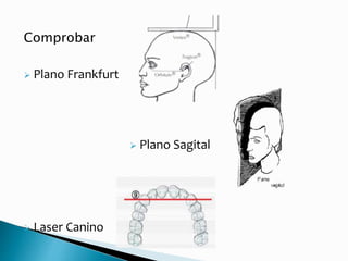 Comprobar
 Plano Frankfurt
 Plano Sagital
 Laser Canino
 