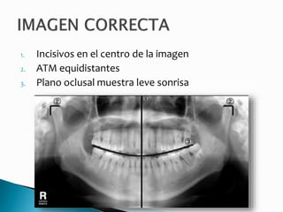 1. Incisivos en el centro de la imagen
2. ATM equidistantes
3. Plano oclusal muestra leve sonrisa
 