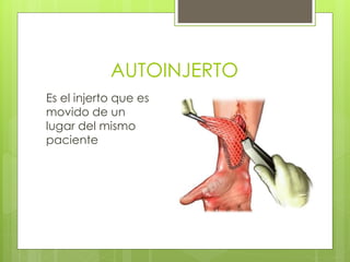 AUTOINJERTO
Es el injerto que es
movido de un
lugar del mismo
paciente
 