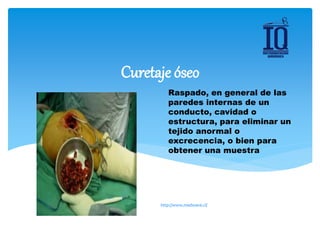 Raspado, en general de las
paredes internas de un
conducto, cavidad o
estructura, para eliminar un
tejido anormal o
excrecencia, o bien para
obtener una muestra
Curetaje óseo
http://www.medwave.cl/
 