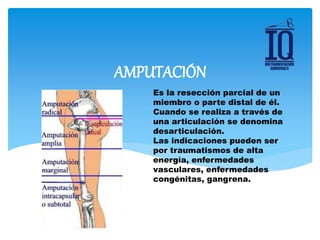 Es la resección parcial de un
miembro o parte distal de él.
Cuando se realiza a través de
una articulación se denomina
desarticulación.
Las indicaciones pueden ser
por traumatismos de alta
energía, enfermedades
vasculares, enfermedades
congénitas, gangrena.
AMPUTACIÓN
 