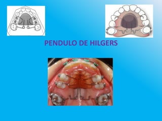 PENDULO DE HILGERS
 