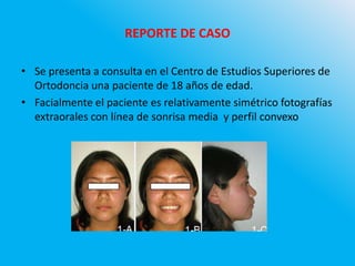REPORTE DE CASO
• Se presenta a consulta en el Centro de Estudios Superiores de
Ortodoncia una paciente de 18 años de edad.
• Facialmente el paciente es relativamente simétrico fotografías
extraorales con línea de sonrisa media y perfil convexo
 