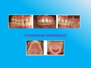 FOTOGRAFIAS INTRAORALES
 