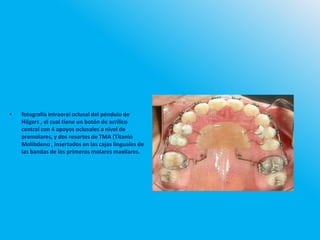 • fotografía intraoral oclusal del péndulo de
Hilgers , el cual tiene un botón de acrílico
central con 4 apoyos oclusales a nivel de
premolares, y dos resortes de TMA (Titanio
Molibdeno , insertados en las cajas linguales de
las bandas de los primeros molares maxilares.
 