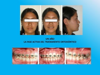 UN AÑO
LA FASE ACTIVA DEL TRATAMIENTO ORTODÓNTICO
 