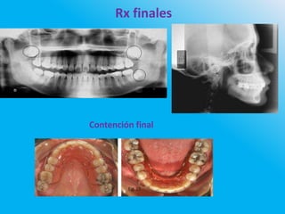 Rx finales
Contención final
 