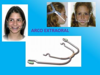 ARCO EXTRAORAL
 