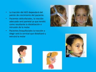• La tracción del AEO dependerá del
patrón de crecimiento del paciente.
• Pacientes dolicofaciales, la tracción
adecuada será parietal ya que tendrá
como resultante la distalización e
intrusión de la molar.
• Pacientes braquifaciales la tracción a
elegir será la cervical que distalizará y
extruirá la molar
 