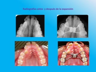 Radiografías antes y después de la expansión
 