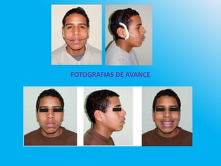 FOTOGRAFIAS DE AVANCE
 