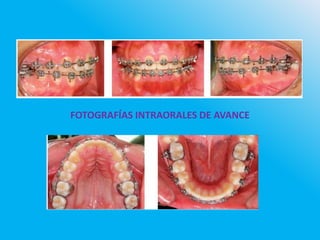 FOTOGRAFÍAS INTRAORALES DE AVANCE
 