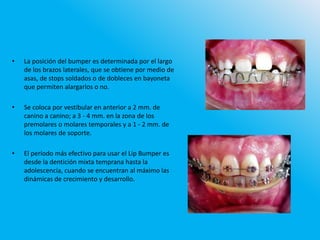 • La posición del bumper es determinada por el largo
de los brazos laterales, que se obtiene por medio de
asas, de stops soldados o de dobleces en bayoneta
que permiten alargarlos o no.
• Se coloca por vestibular en anterior a 2 mm. de
canino a canino; a 3 - 4 mm. en la zona de los
premolares o molares temporales y a 1 - 2 mm. de
los molares de soporte.
• El período más efectivo para usar el Lip Bumper es
desde la dentición mixta temprana hasta la
adolescencia, cuando se encuentran al máximo las
dinámicas de crecimiento y desarrollo.
 
