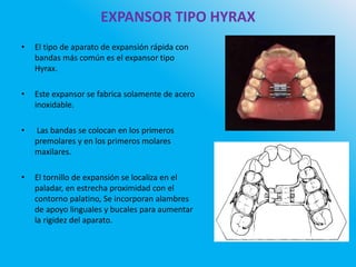 EXPANSOR TIPO HYRAX
• El tipo de aparato de expansión rápida con
bandas más común es el expansor tipo
Hyrax.
• Este expansor se fabrica solamente de acero
inoxidable.
• Las bandas se colocan en los primeros
premolares y en los primeros molares
maxilares.
• El tornillo de expansión se localiza en el
paladar, en estrecha proximidad con el
contorno palatino, Se incorporan alambres
de apoyo linguales y bucales para aumentar
la rigidez del aparato.
 