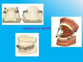 APARATO DE HERBTS
 