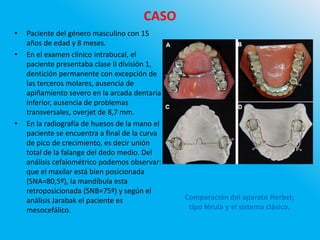 CASO
• Paciente del género masculino con 15
años de edad y 8 meses.
• En el examen clínico intrabucal, el
paciente presentaba clase II división 1,
dentición permanente con excepción de
las terceros molares, ausencia de
apiñamiento severo en la arcada dentaria
inferior, ausencia de problemas
transversales, overjet de 8,7 mm.
• En la radiografía de huesos de la mano el
paciente se encuentra a final de la curva
de pico de crecimiento, es decir unión
total de la falange del dedo medio. Del
análisis cefalométrico podemos observar:
que el maxilar está bien posicionada
(SNA=80,5º), la mandíbula esta
retroposicionada (SNB=75º) y según el
análisis Jarabak el paciente es
mesocefálico.
Comparación del aparato Herbst;
tipo férula y el sistema clásico.
 