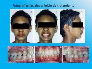 Fotografías faciales al inicio de tratamiento
 
