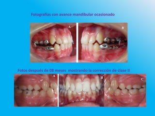 Fotografías con avance mandibular ocasionado
Fotos después de 08 meses mostrando la corrección de clase II
 