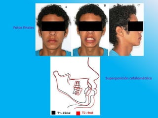 Fotos finales
Superposición cefalométrica
 