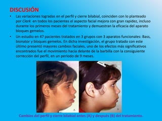 DISCUSIÓN
• Las variaciones logradas en el perfil y cierre bilabial, coinciden con lo planteado
por Clark en todos los pacientes el aspecto facial mejora con gran rapidez, incluso
durante los primeros meses del tratamiento y demuestran la eficacia del aparato
bloques gemelos.
• Un estudio en 47 pacientes tratados en 3 grupos con 3 aparatos funcionales: Bass,
bionator y bloques gemelos. En dicha investigación, el grupo tratado con este
último presentó mayores cambios faciales, uno de los efectos más significativos
encontrados fue el movimiento hacia delante de la barbilla con la consiguiente
corrección del perfil, en un período de 9 meses.
Cambios del perfil y cierre bilabial antes (A) y después (B) del tratamiento.
 