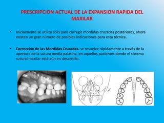 PRESCRIPCION ACTUAL DE LA EXPANSION RAPIDA DEL
MAXILAR
• Inicialmente se utilizó sólo para corregir mordidas cruzadas posteriores, ahora
existen un gran número de posibles indicaciones para esta técnica.
• Corrección de las Mordidas Cruzadas. se resuelve rápidamente a través de la
apertura de la sutura media palatina, en aquellos pacientes donde el sistema
sutural maxilar está aún en desarrollo.
 