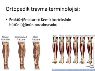 Ortopedik travma terminolojisi:
• Fraktür(Fracture): Kemik korteksinin
bütünlüğünün bozulmasıdır.
 