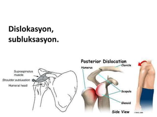 Dislokasyon,
subluksasyon.
 