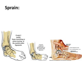 Sprain:
 