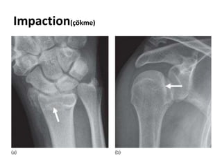 Impaction(çökme)
 
