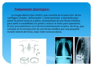 Ravitch Incision Ortopedia infantil.ppt