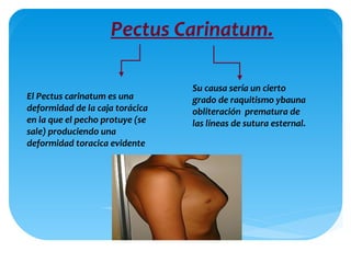 Pectus Carinatum.
El Pectus carinatum es una
deformidad de la caja torácica
en la que el pecho protuye (se
sale) produciendo una
deformidad toracica evidente
Su causa sería un cierto
grado de raquitismo ybauna
obliteración prematura de
las líneas de sutura esternal.
 